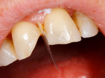Comnposite filling tooth treatment
