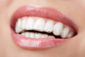 Home Tooth Whitening