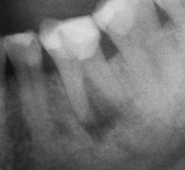 Infected Tooth - Root Canal Therapy