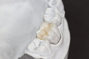 Porcelain Onlays - Dental Onlay On a Cast Model